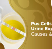Pus Cells in Urine: Understanding the Test, Causes, and What Your Results Mean