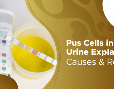 Pus Cells in Urine: Understanding the Test, Causes, and What Your Results Mean
