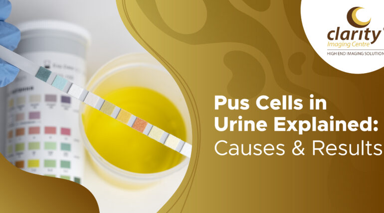Pus Cells in Urine: Understanding the Test, Causes, and What Your Results Mean