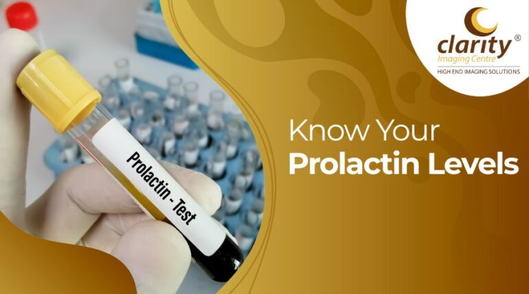 Blood collection tube labeled for prolactin hormone test.