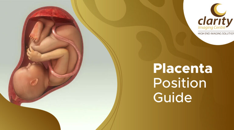 posterior placenta