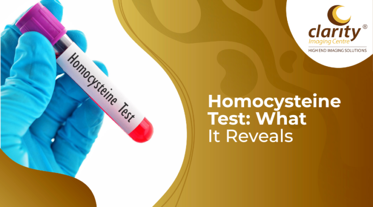 homocysteine test