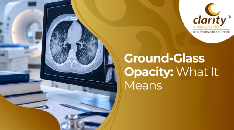 ground-glass opacity